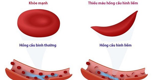 bệnh hồng cầu hình liềm