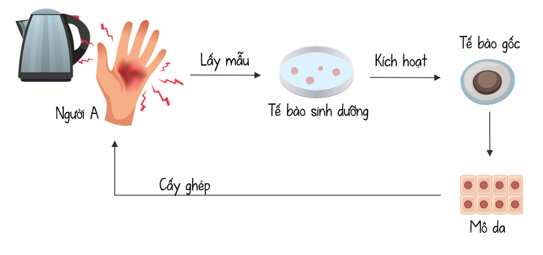 Cấy ghép mô da cho người bị bỏng