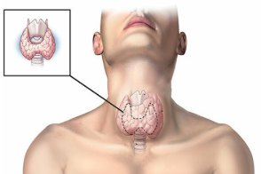 Bệnh bướu cổ.olm