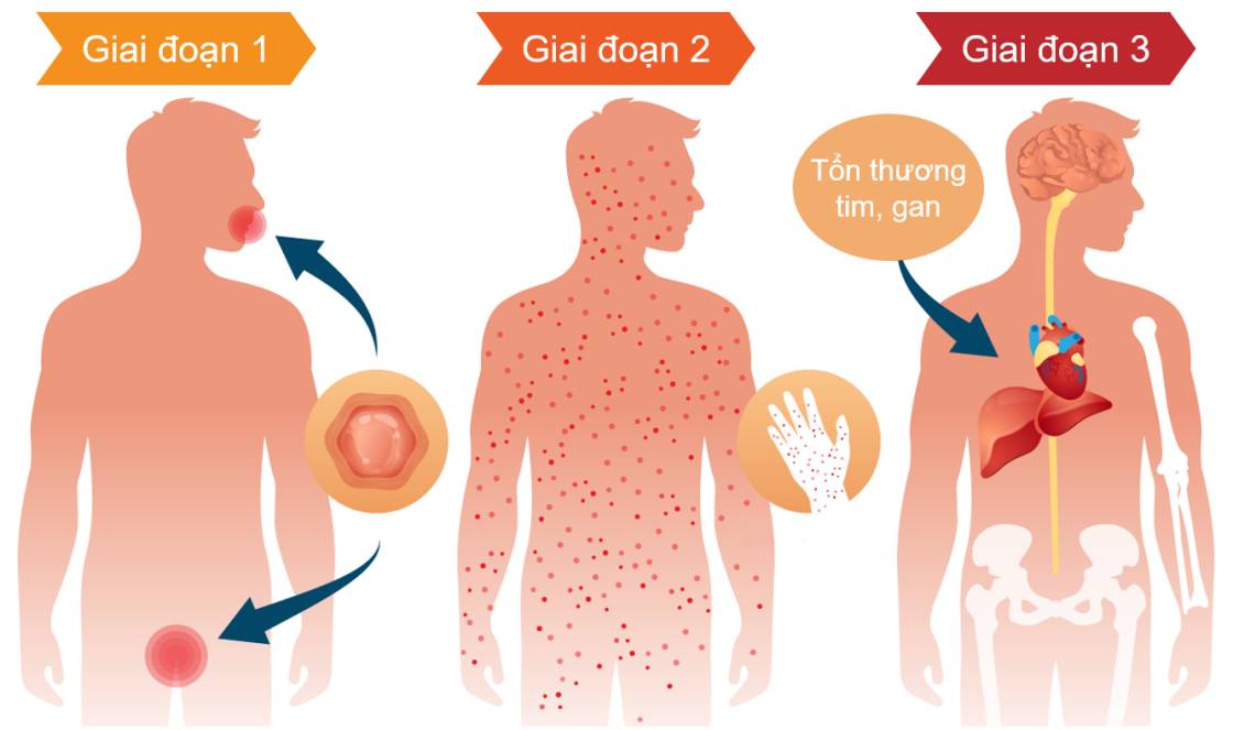 Triệu chứng của người mắc bệnh giang mai