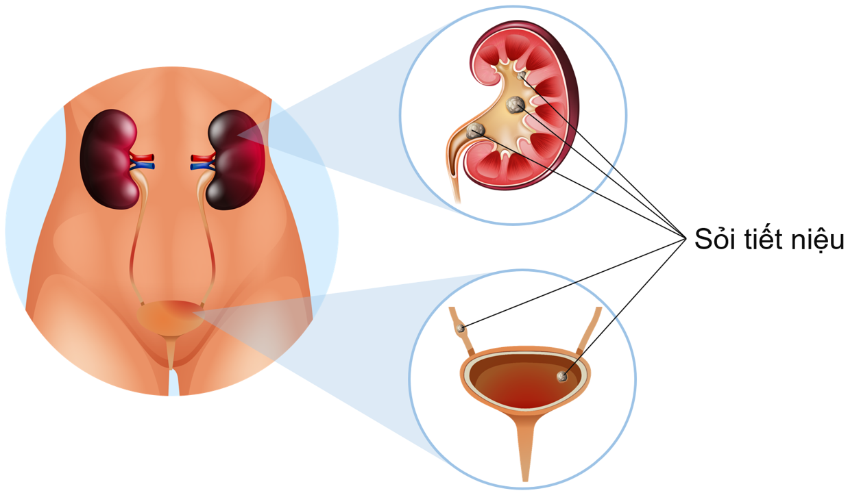 Bệnh sỏi đường tiết niệu