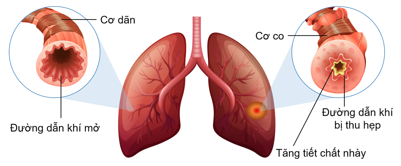 Phế quản của người bình thường và người mắc bệnh hô hấp