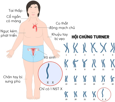 sinh học 12, hội chứng Turner