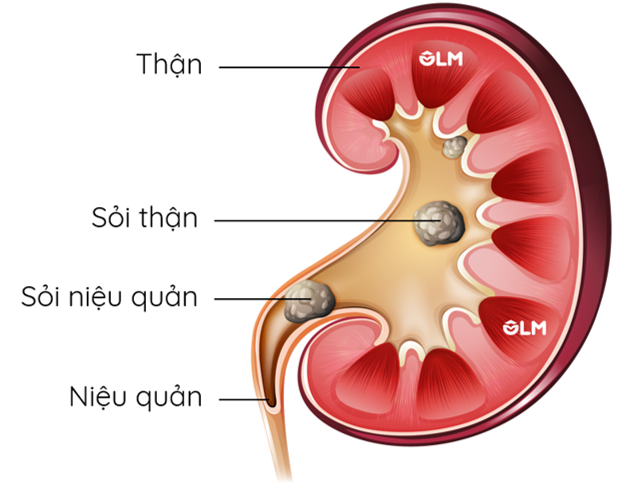 Sỏi đường tiết niệu