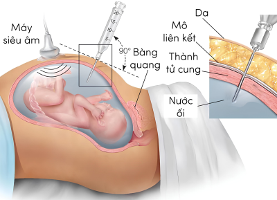 sinh học 12, kĩ thuật chọc lấy dịch ối