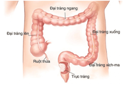 Ruột già và trực tràng