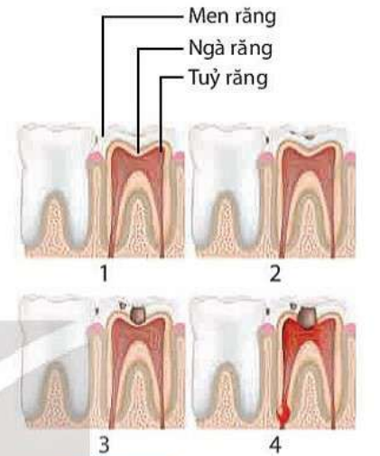 Các giai đoạn sâu răng