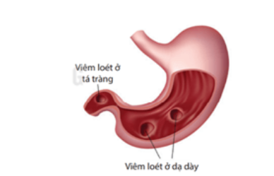 Dạ dày và tá tràng bị viêm loét