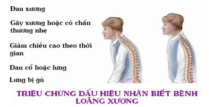 một số triệu chứng bệnh loãng xương