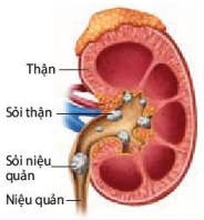 Sỏi đường tiết niệu