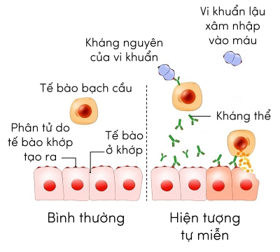 Sinh 11, hiện tượng tự miễn ở người do vi khuẩn lậu