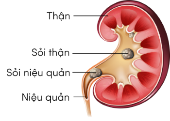 Sinh 11, sỏi thận và đường tiết niệu