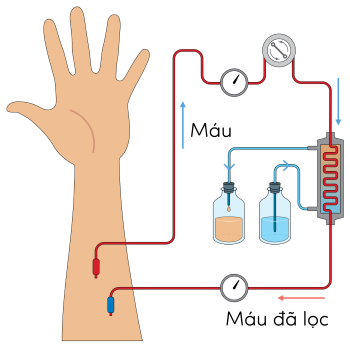 Sinh 11, chạy thận nhân tạo