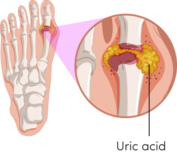 KHTN 8, bệnh Gout