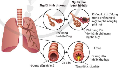 Phế nang, phế quản ở người bình thường và người mắc bệnh hô hấp 