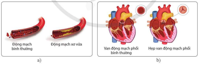 Bệnh xơ vữa động mạch (a) và bệnh hẹp van động mạch phổi (b)